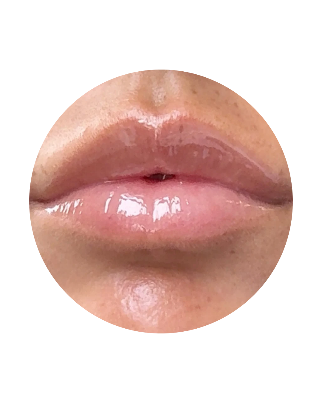 Resultado final de labios voluminosos